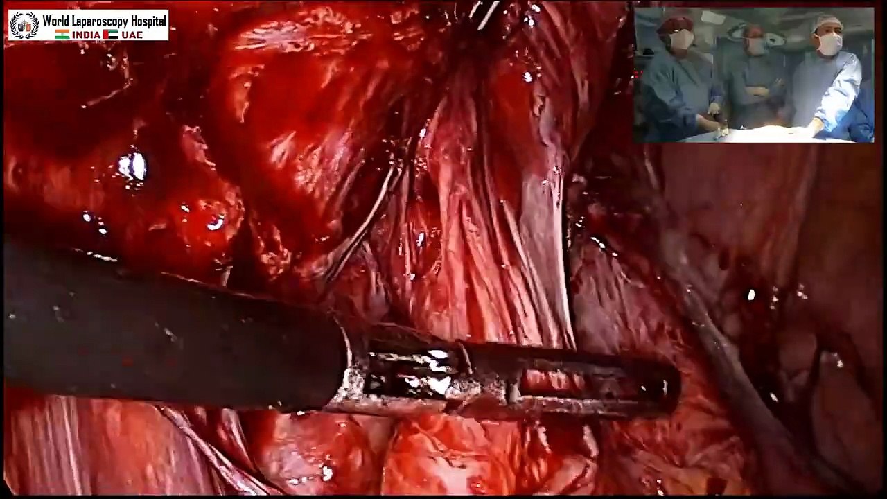 Recurrent Incisional Hernia with Severe Small Bowel Adhesion with Subacute Obstruction