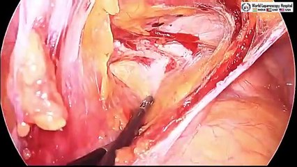 Laparoscopic Management of Suprapubic Incisional  Hernia