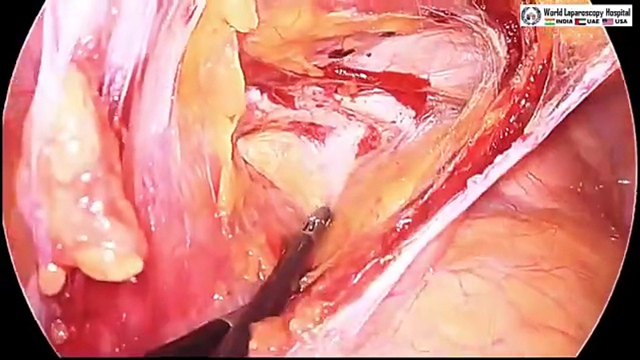 Laparoscopic Management of Suprapubic Incisional  Hernia