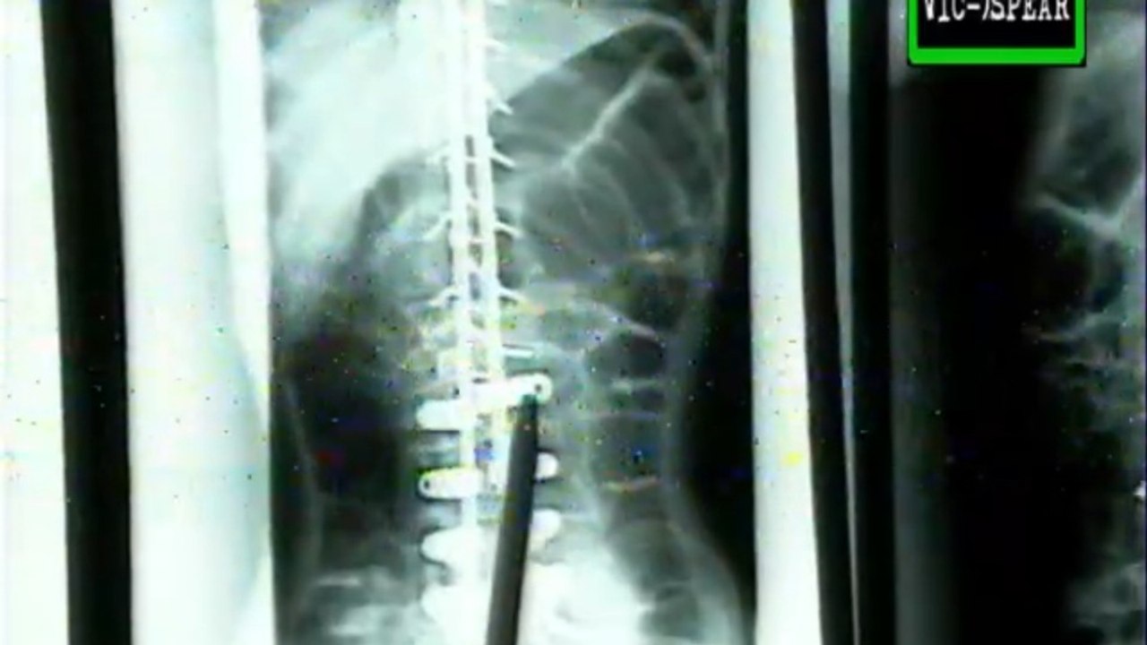 Avances Médicos: Lesiones en la Columna Vertebral - Documental (1999) Español Latino