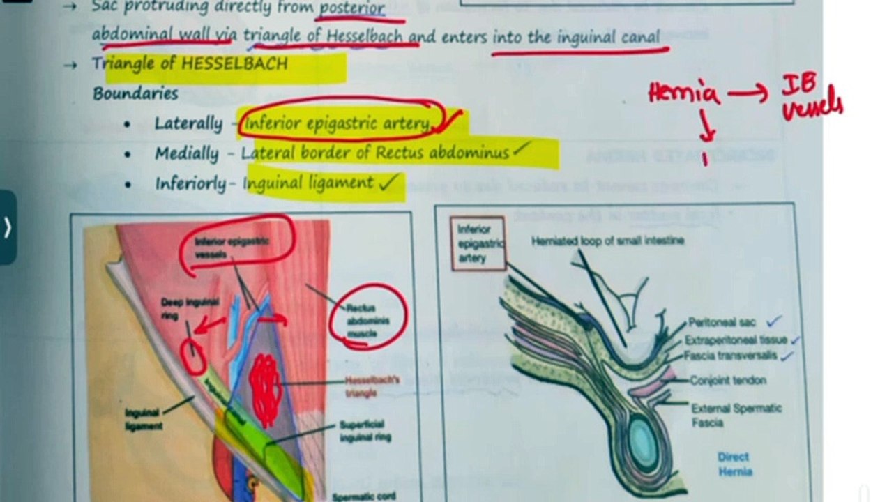 Hernia in detail