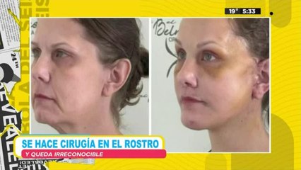 Se hace cirugía en el rostro y queda irreconocible