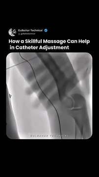 Mastering Catheter Adjustment with Gentle Massage Techniques 💆‍♂️