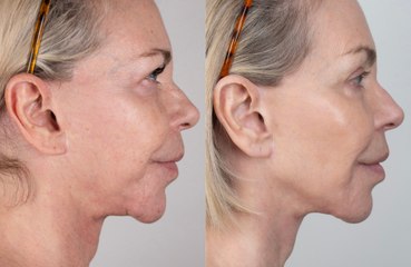 Leslie Ash has found her confidence again due to having a non-surgical facelift