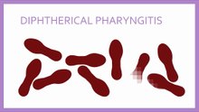 Treatment of diphtherical pharyngitis