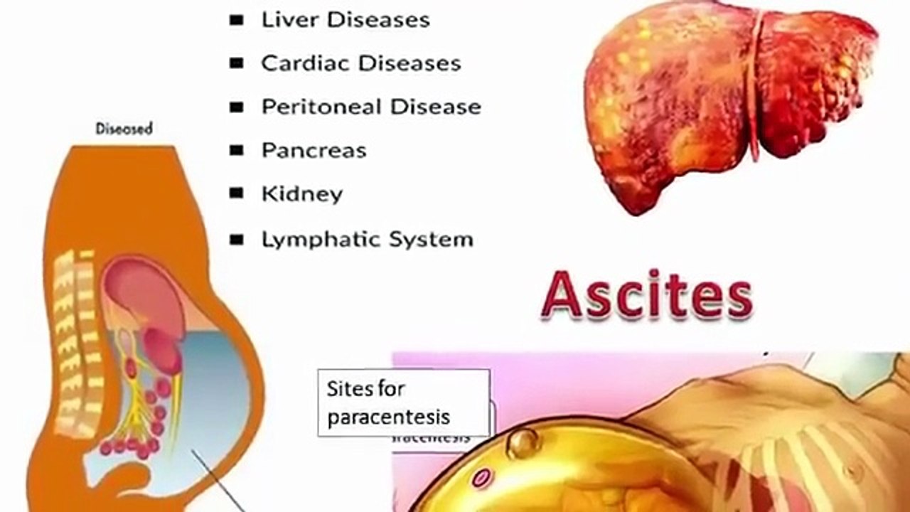 Dr. ZeeHuge Belly but NOT Fat (Cirrhosis & Ascites) डॉक्टर ज़ी - Dr. Zee (360p, h264)