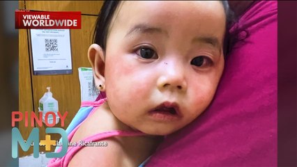 8-month old na sanggol, tinamaan ng Kawasaki Disease! | Pinoy MD
