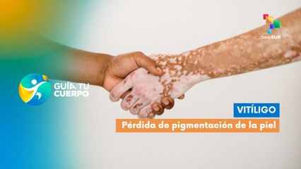 Vitíligo | Una enfermedad de la piel caracterizada por la pérdida de pigmentación