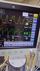 Monitoring & maintenance of a low reserve cardiac patient (EF-33)