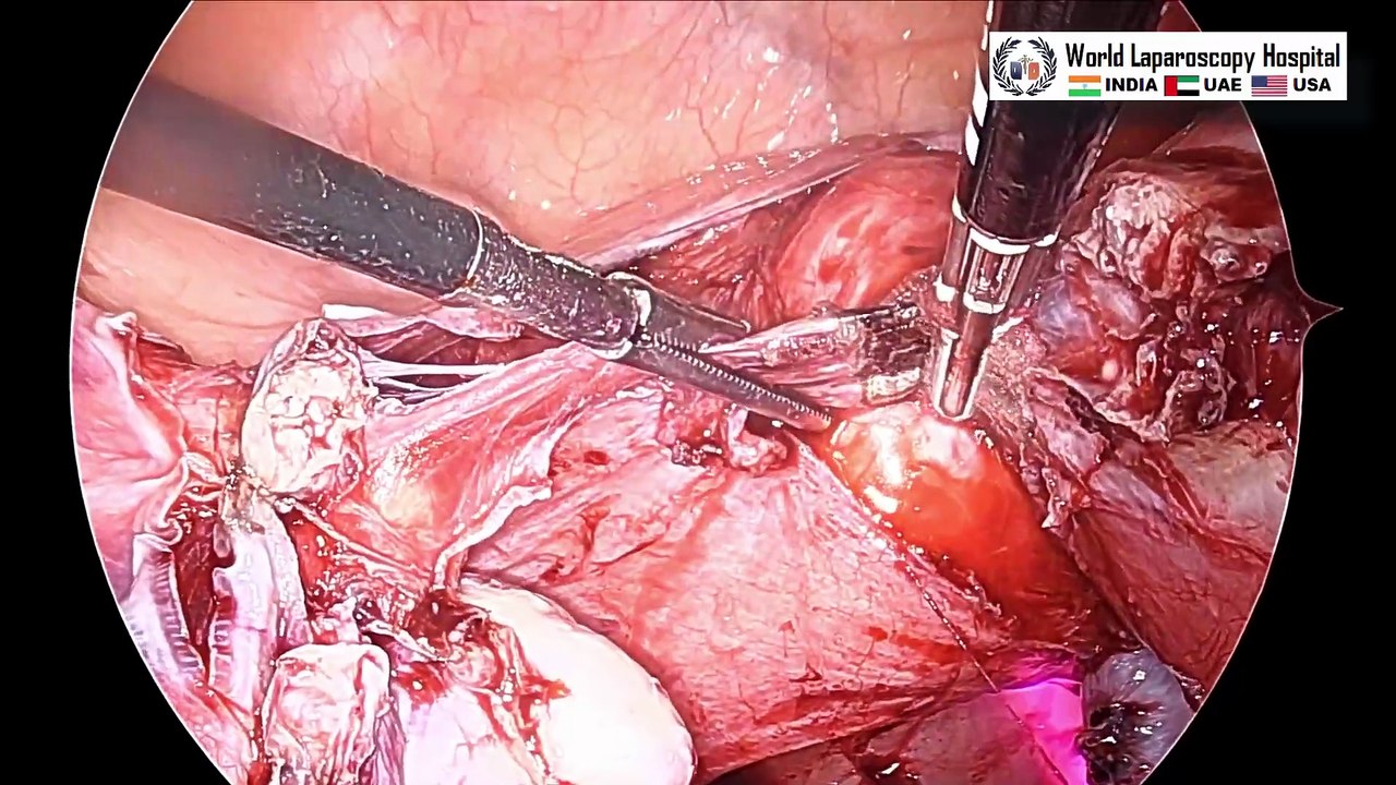 TLH and Appendectomy with Three 5 mm Ports Approach to Gynecological and Appendiceal Surgery