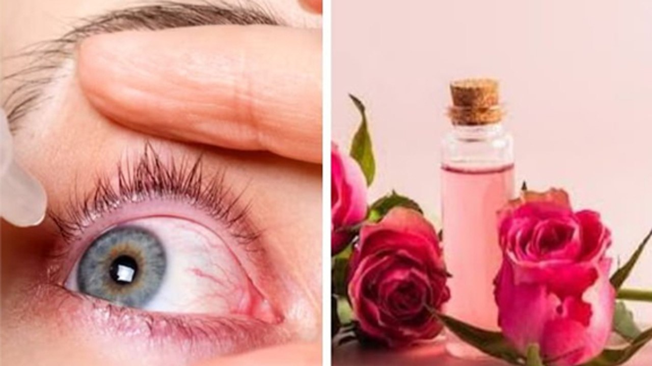 Monsoon Eye Infection Causes:बरसात में आंखों के संक्रमण का इलाज कैसे करें,Symptoms & Treatment...