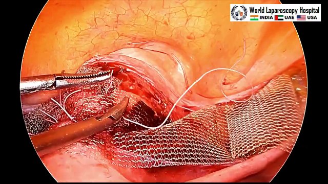 Laparoscopic Pectopexy for Apical Uterine Prolapse: Satisfactory Minimal Access Surgical Approach