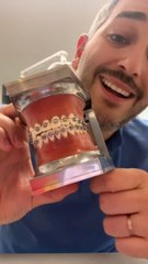 Tout savoir sur le brossage avec des bagues : conseils et astuces 🦷