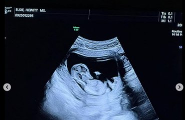 Pete Davidson y Elsie Hewitt están esperando su primer hijo