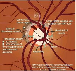 Optic Nerve in Glaucoma