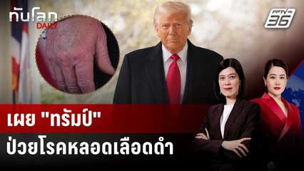 เผย “ทรัมป์ ป่วย "ภาวะหลอดเลือดดำบกพร่อง" หลังมือช้ำ-ขาบวม | ทันโลก DAILY | 18 ก.ค. 68