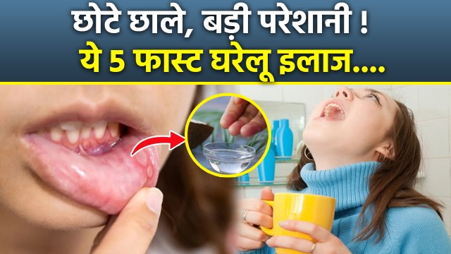 Mouth Ulcer Causes: मुंह के छालों से मिलेगा छुटकारा, ये 5 घरेलू नुस्खे देंगे आराम | Boldsky