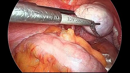 Laparoscopic Surgery For Ovarian Dermoid Cyst
