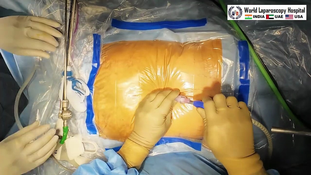 Total Laparoscopic Hysterectomy with Right Inguinal and Left Incisional hernia repair by three-port