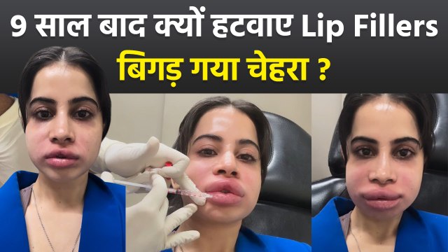 Urfi Javed Face Swelling: 9 Years बाद क्यों कराए Lip Filler Dissolve Shares Video,Public Troll