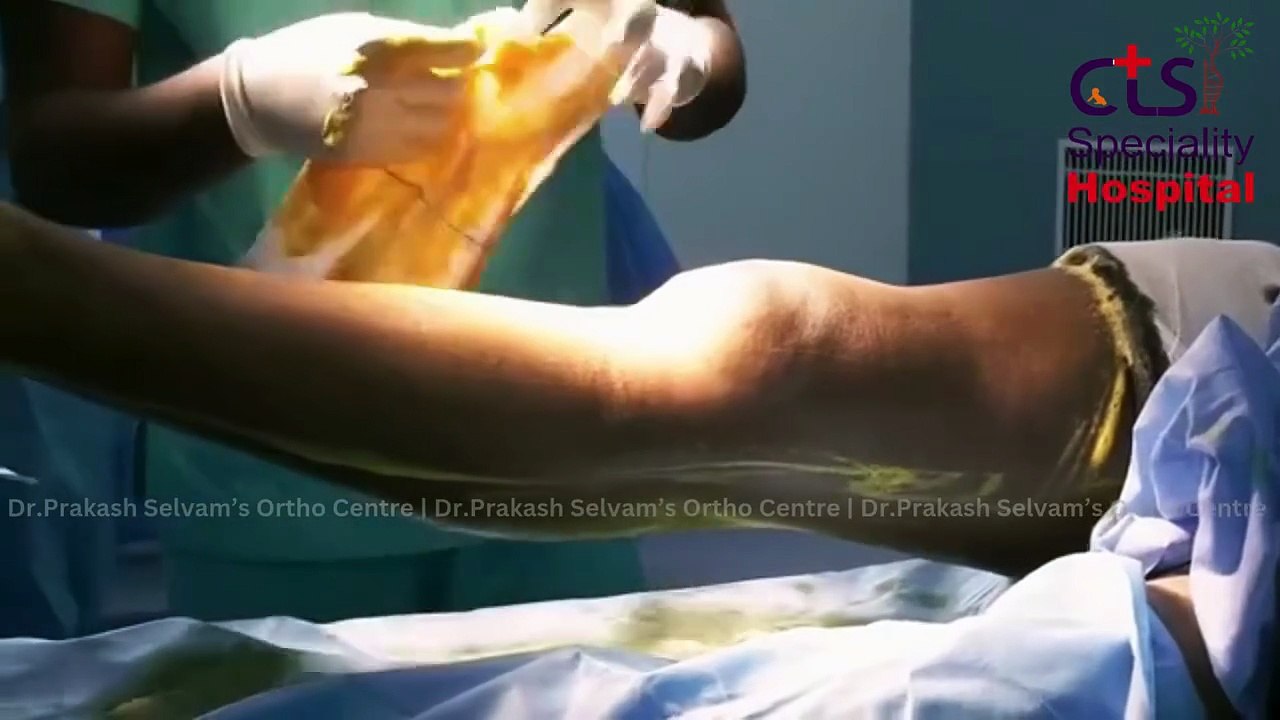 Robotic knee replacement in Chennai