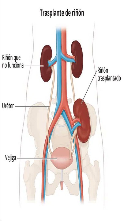 Trasplante * de riñón explicado fácilmente