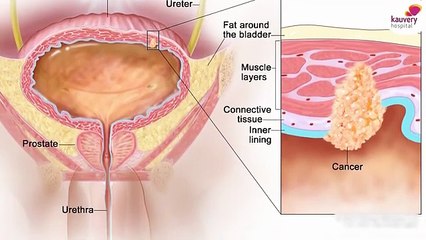 Renal tumours: What you need to know