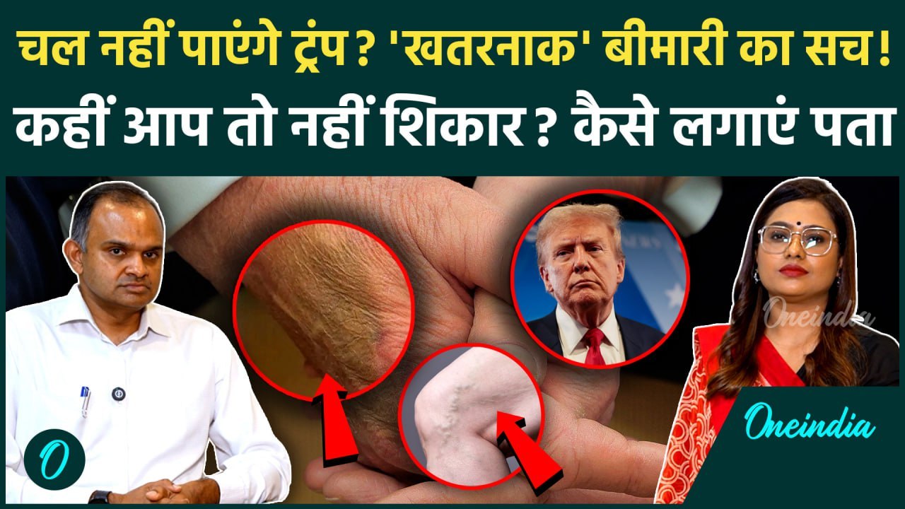 Trump को हुई नसों की ये बीमारी, Doctor ने बताया कितनी है 'Dangerous', सब कुछ A to Z | Health