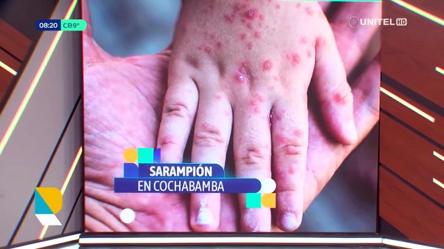 Sedes afirma que solo uno de los dos pacientes con sarampión en Cochabamba puede llegar a contagiar