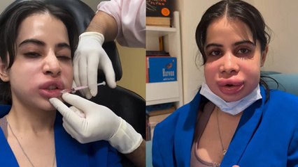 Urfi Javed Lip Fillers Video : कितना होता है Swelling Treatment और Cost ? Lip Fillers Side Effects