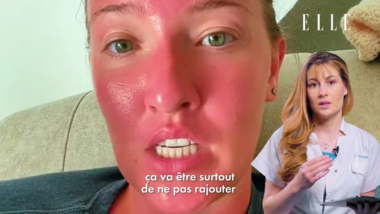 OK Expert : que se passe-t-il vraiment quand on prend un coup de soleil ?