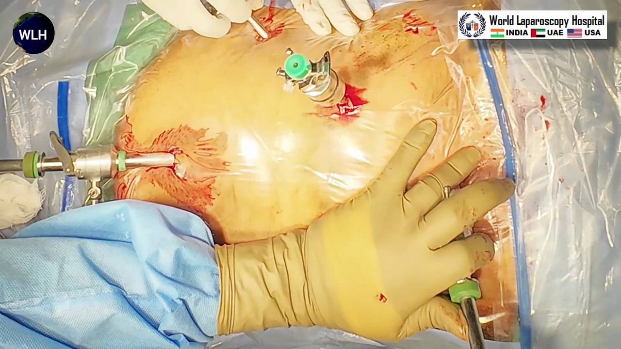 Comprehensive Skin to Skin Video Guide to Laparoscopic Cholecystectomy Techniques and Best Practices