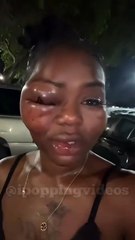 This woman got into a serious fight, leaving half of her face swollen and her eye swollen shut