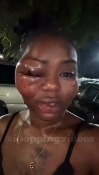 This woman got into a serious fight, leaving half of her face swollen and her eye swollen shut
