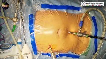 Enhancing Laparoscopic Hysterectomy Surgery_ TLH and BSO with ICG Guidance - A Step-by-Step Tutorial
