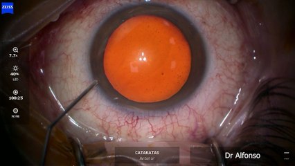 SALUD | Así se realiza una operación de cataratas