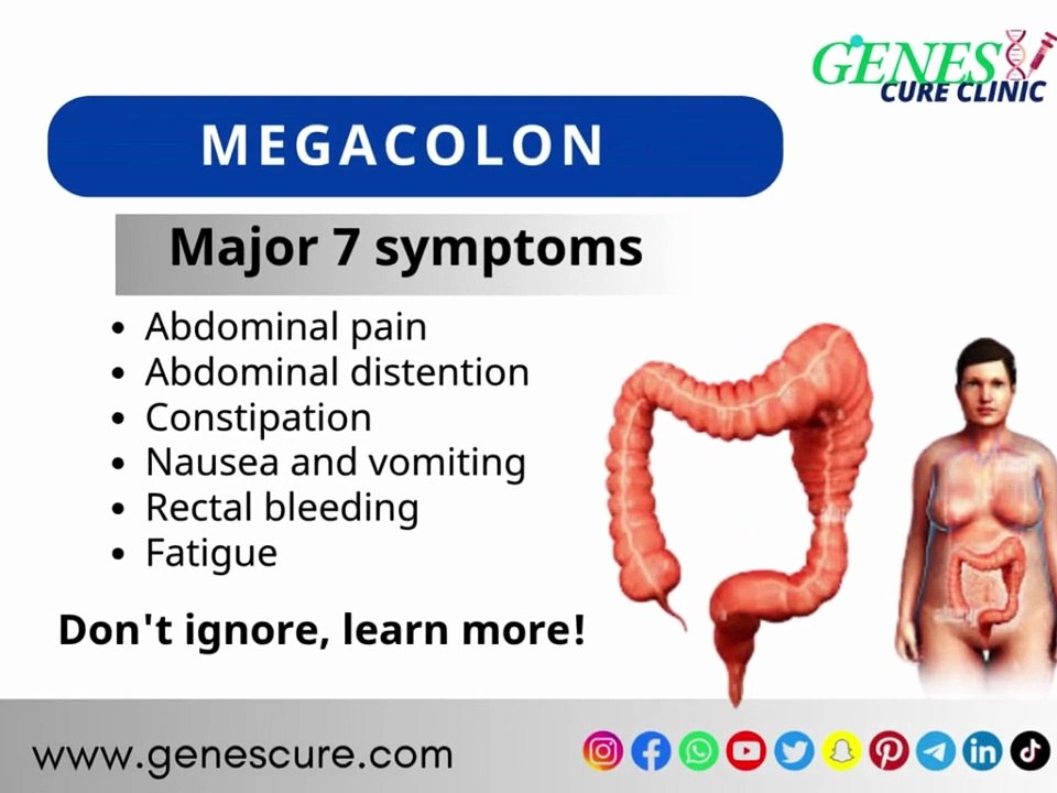 Understanding Megacolon: Causes, Symptoms, and Management