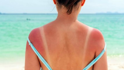 "Sunburn Challenge", il pericoloso trend social che brucia la pelle dei giovani