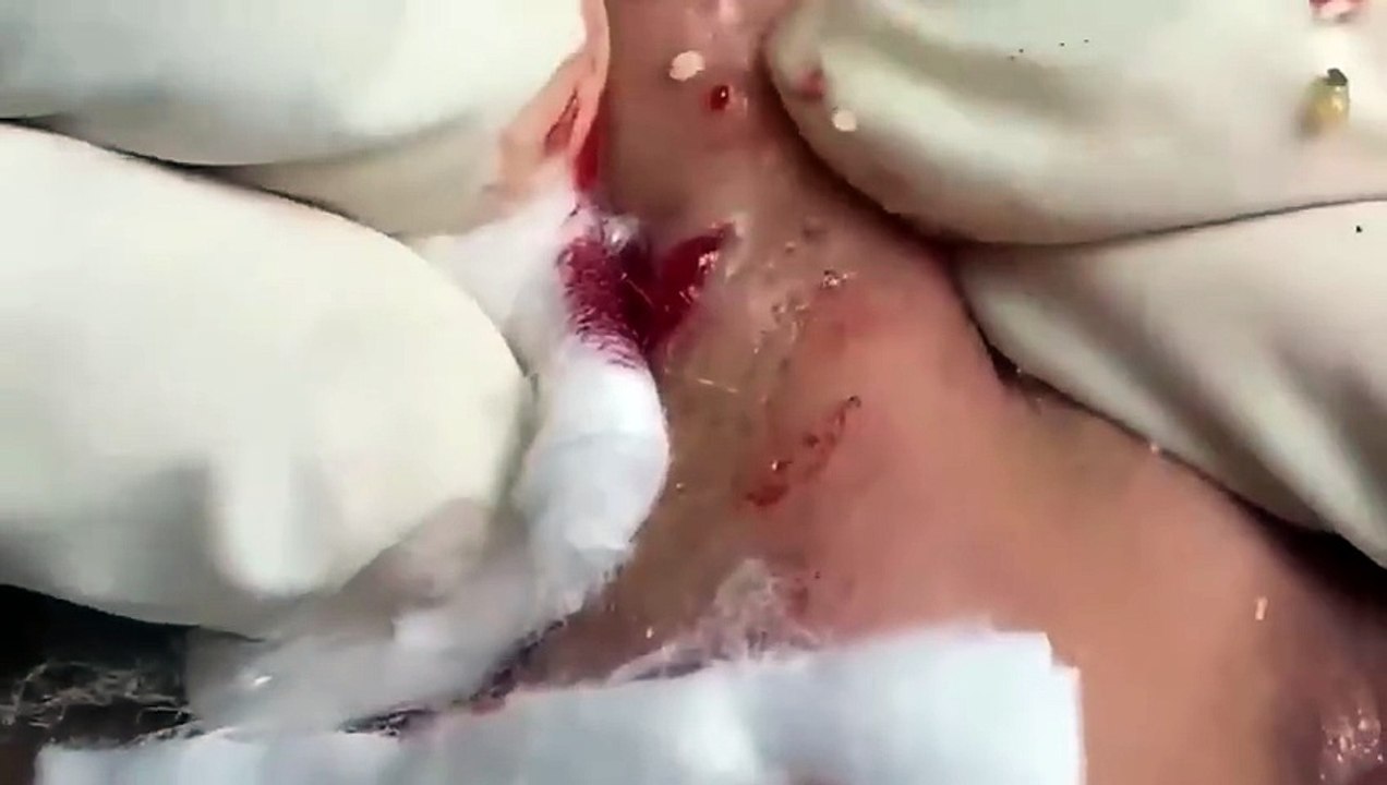 relaxing blackheads removal pimple popping videos blackheads removal large blackheads popping