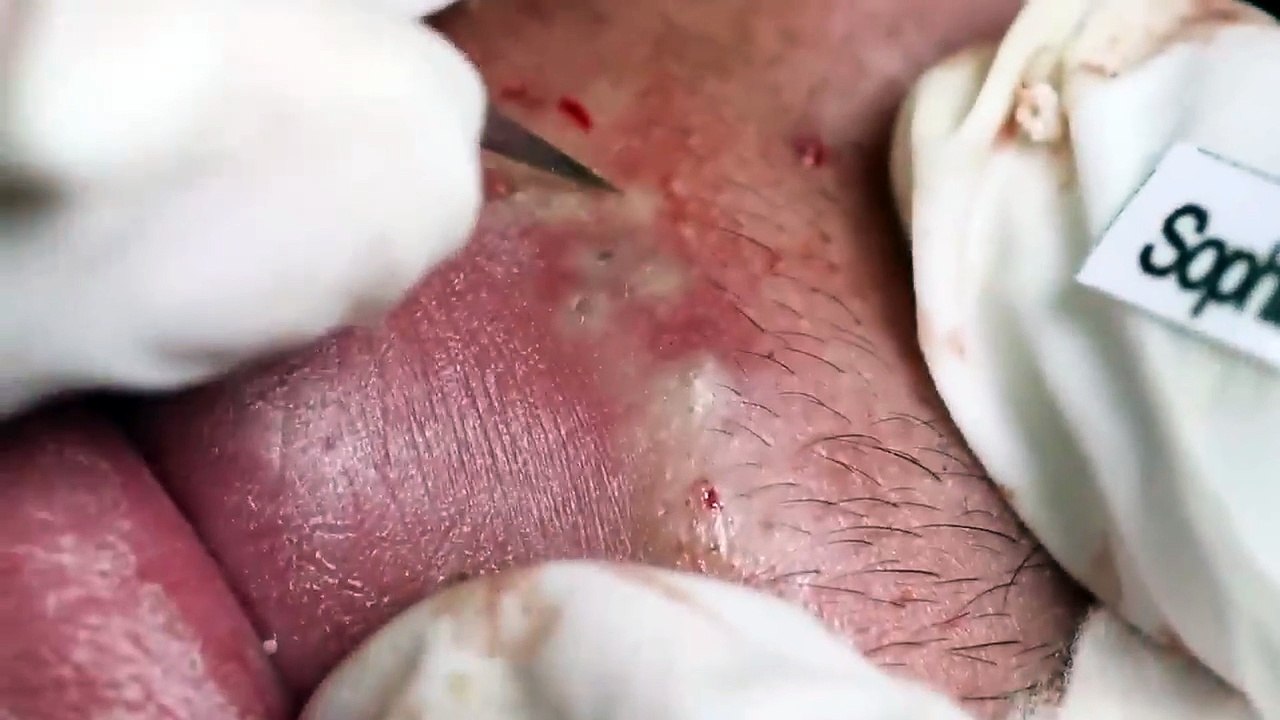 Daily Video Relaxing Skin Care, Acne, Whiteheads & Blackheads