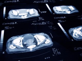 Tumore alla prostata: il ruolo dell?intelligenza artificiale