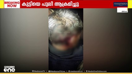 പുലിയുടെ ആക്രമണത്തിൽ ഗുരുതര പരിക്കേറ്റ  നാലു വയസുകാരനെ തൃശ്ശൂർ മെഡി.കോളജിലേക്ക് മാറ്റി