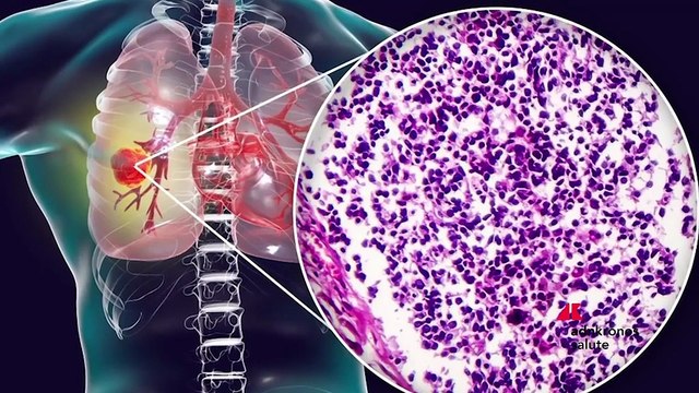 Giornata cancro polmone, Novello (UniTo): In carcinoma a piccole cellule prima innovazione in 20 anni