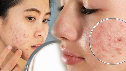 Pimple Increasing Reasons: चेहरे पर बार बार हाथ लगाने से मुंहासे बढ़ते है | Boldsky