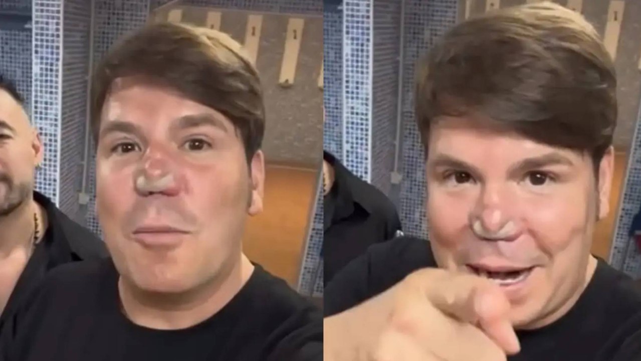 Nueva polémica por la nariz de Lucas, de Andy y Lucas