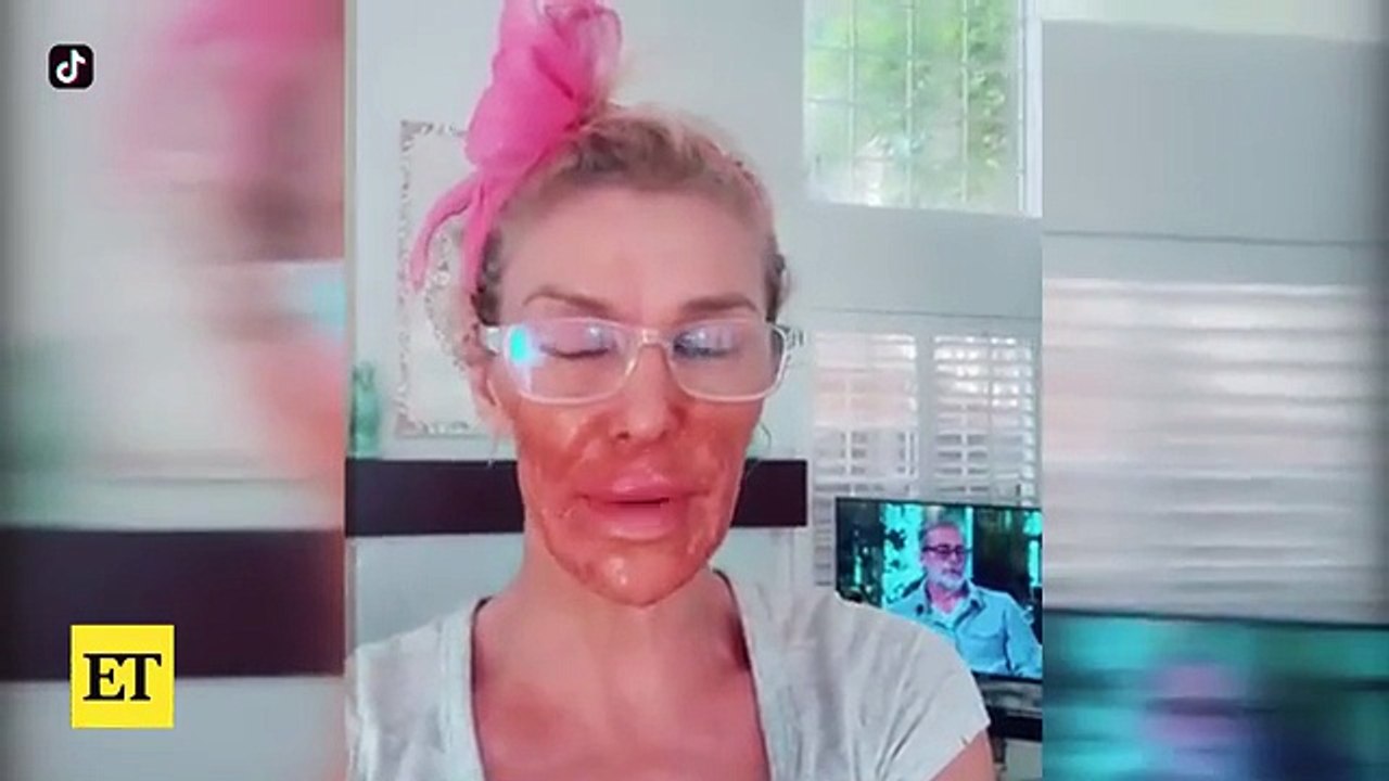 Brandi Glanville Gets CHEMICAL BURN on Face Amid Health Battle