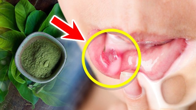Muh Ke Chhale Ka 1 Raat Me Ilaj Kaise Kre,Muh Ke Chhale Ko Kaise Thik Kare| Mouth Ulcer Treatment..