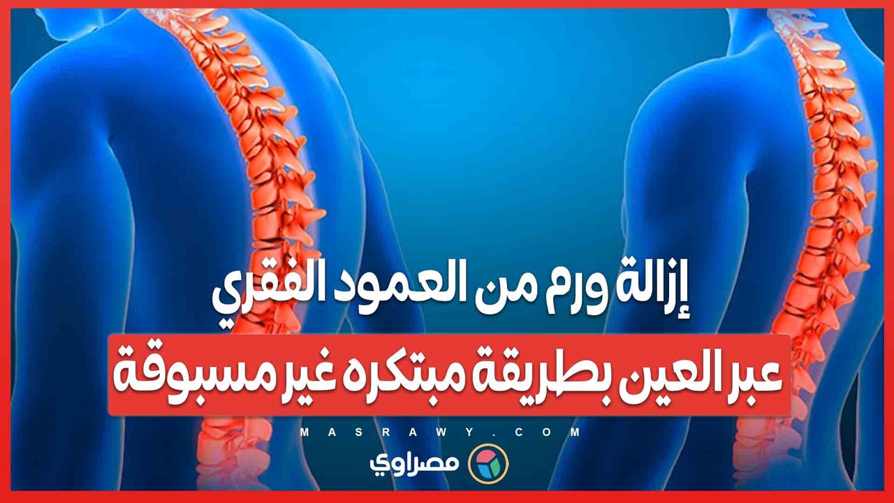 إزالة ورم من العمود الفقري عبر العين بطريقة مبتكره غير مسبوقة .. ماذا حدث؟