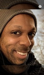 Muere un joven de 38 años al hacerse un injerto capilar en Turquía