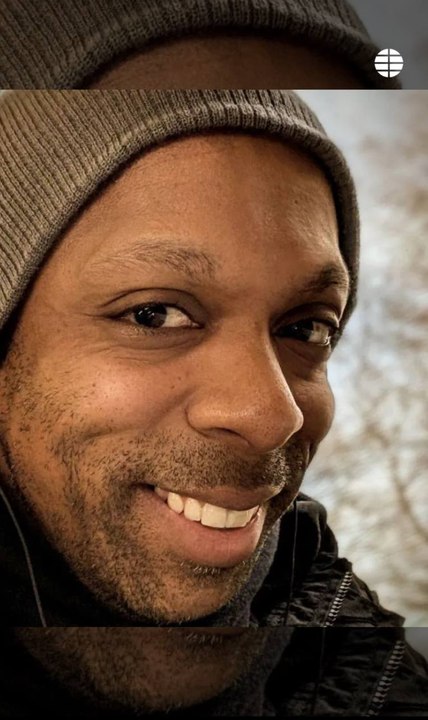 Muere un joven de 38 años al hacerse un injerto capilar en Turquía